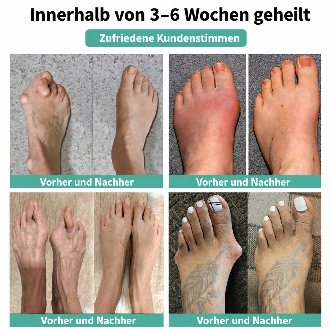 🏅 Natravor® Botanisches Komfort-Pflaster bei Hallux valgus 👠 Flexible Fußpflege + pflanzlich inspirierte Komfortformel
