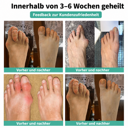 🏅 Natravor® Botanisches Komfort-Pflaster bei Hallux valgus 👠 Flexible Fußpflege + pflanzlich inspirierte Komfortformel